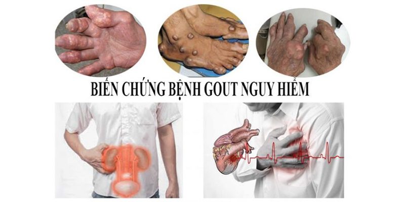 Tìm hiểu chung về căn bệnh Gout